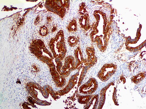 IHC of CEA on an FFPE Colon Adenocarcinoma Tissue
